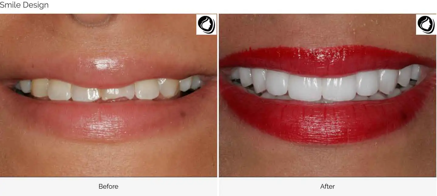 Complete cosmetic smile design, before and after