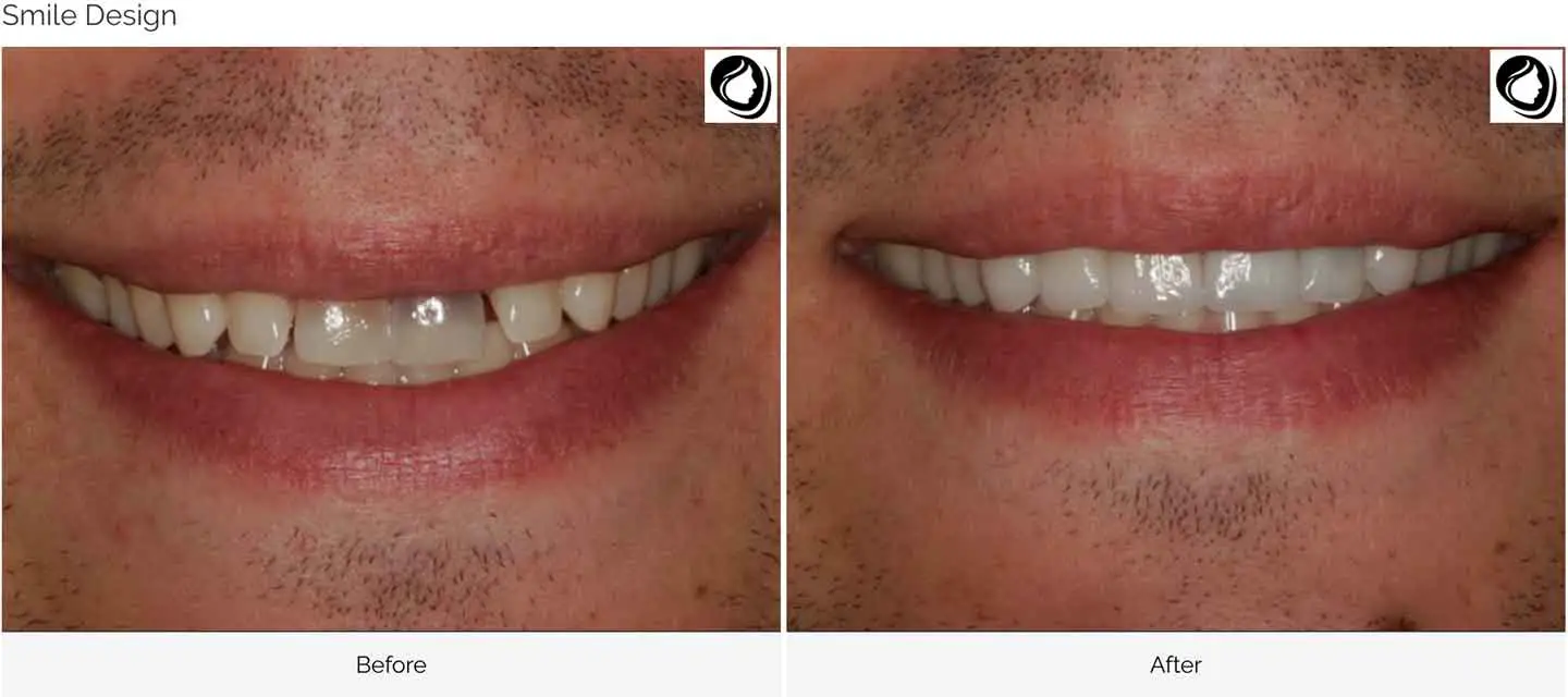Smile design case 3 before and after