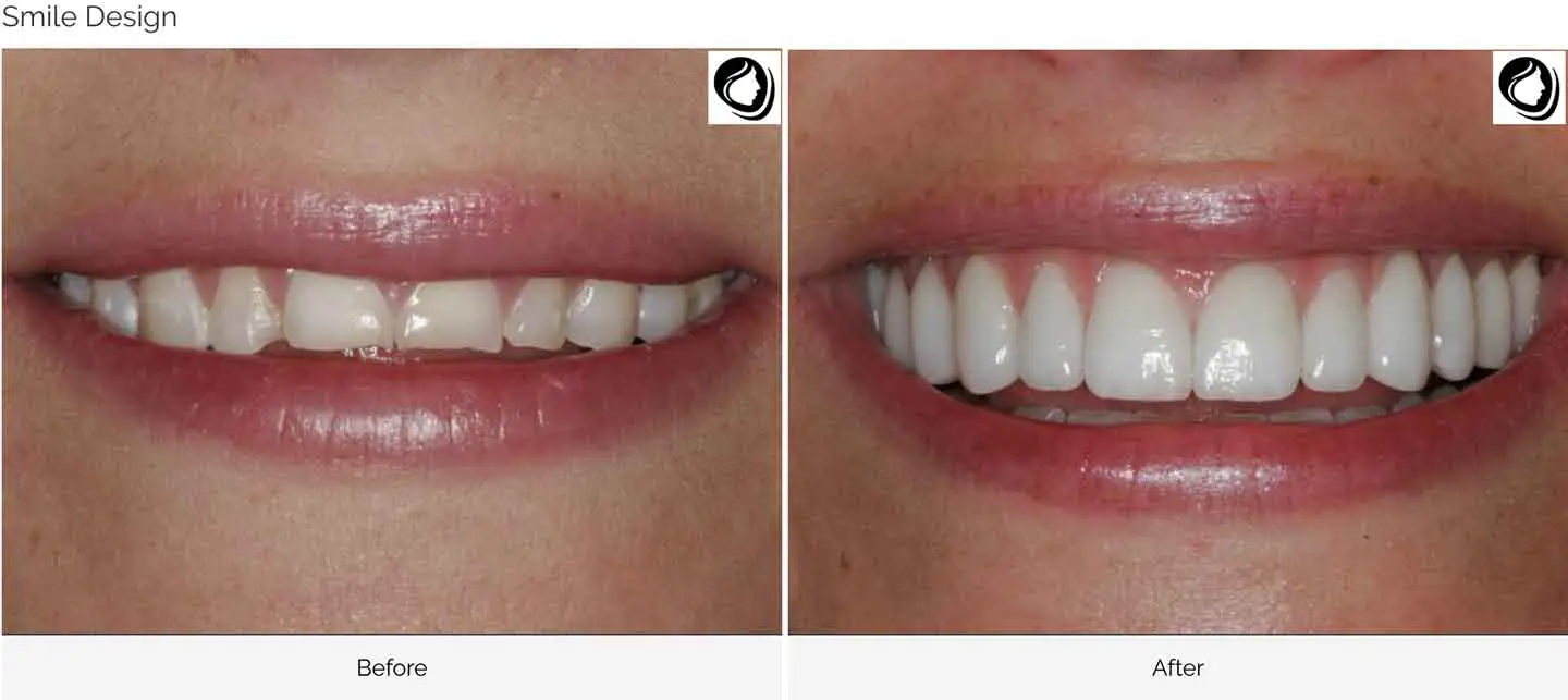 Smile design case 4 before and after