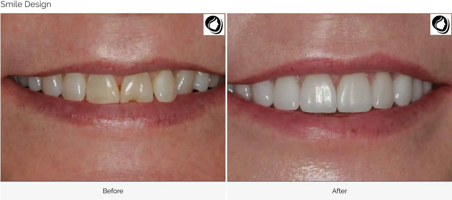 Smile design case 5 before and after