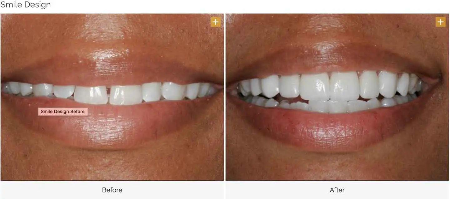 Smile design case 6 before and after