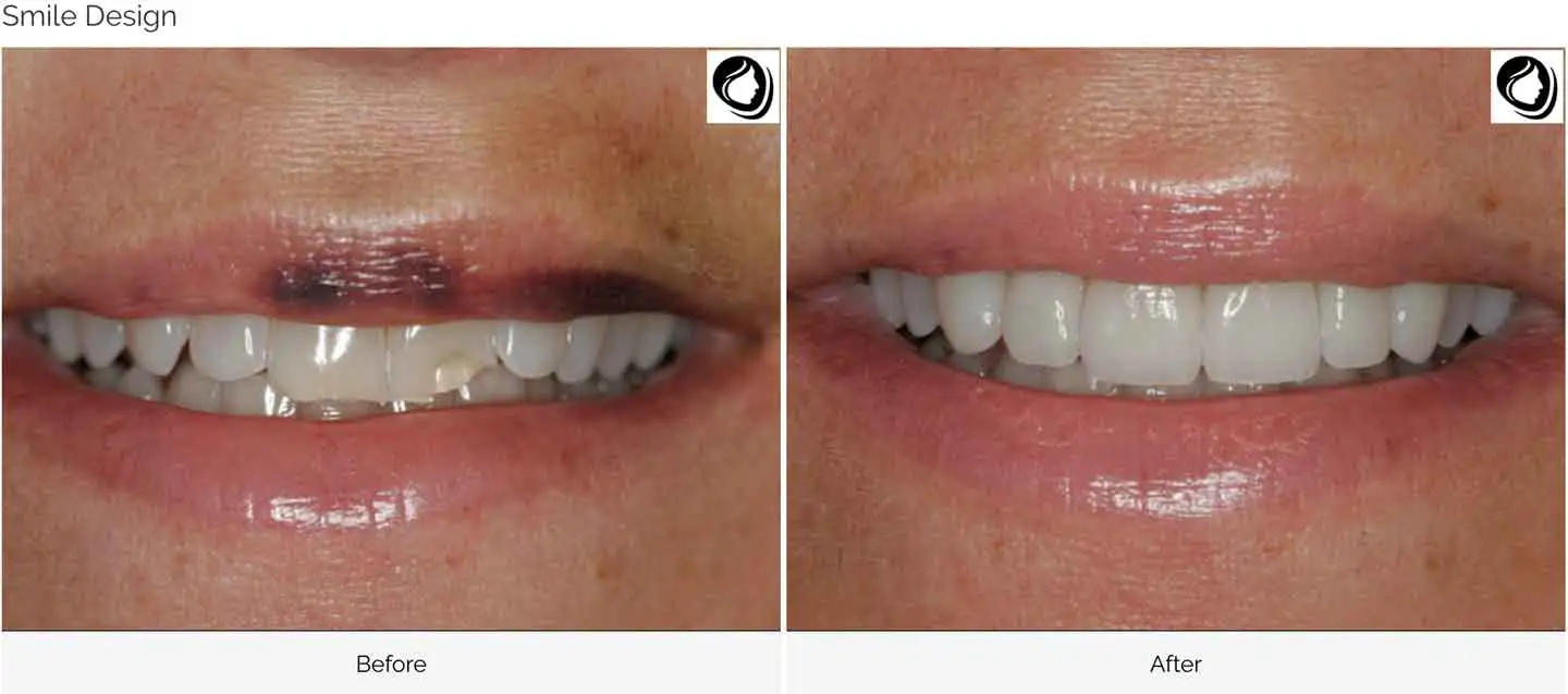 Veneer set with custom shade-matching, before and after