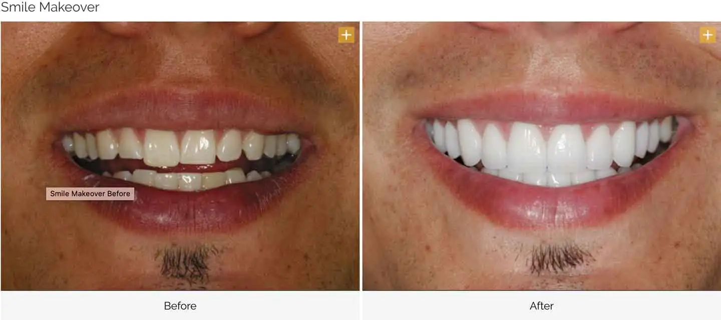 Smile design case 9 before and after