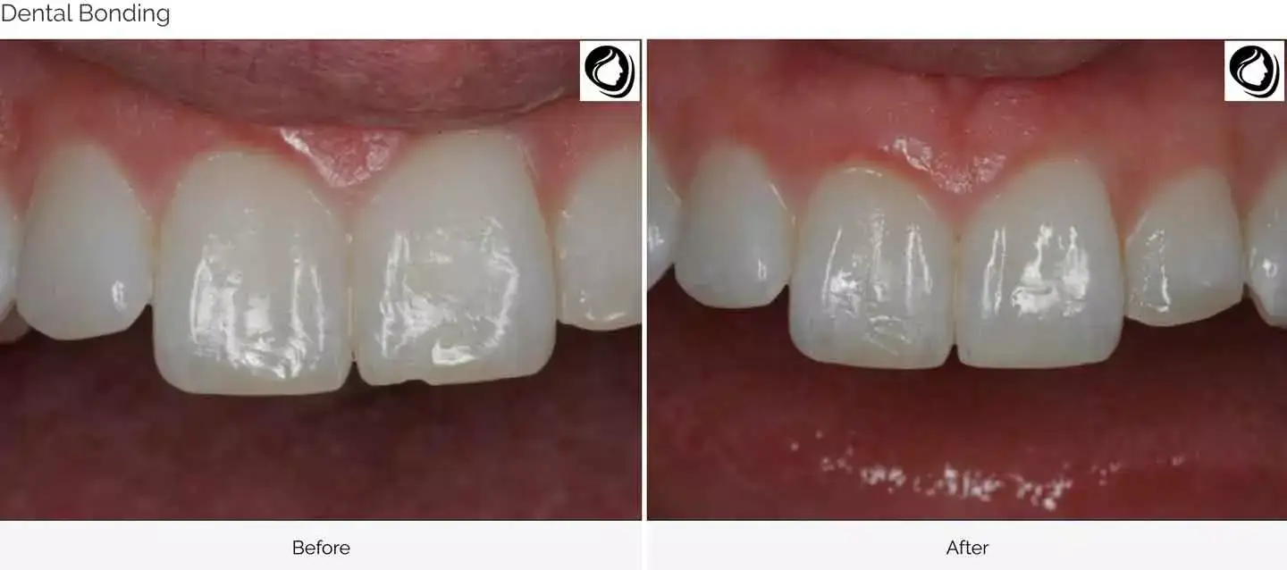 Conservative chipped-tooth repair, before and after