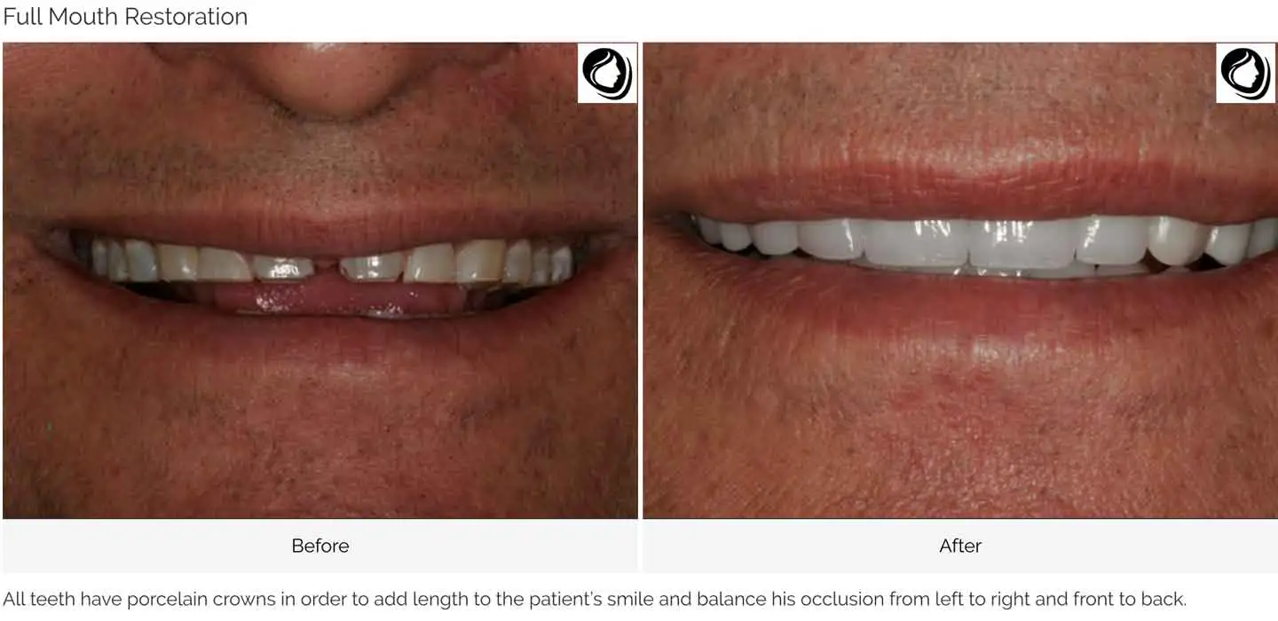 Implant-supported full restoration, before and after