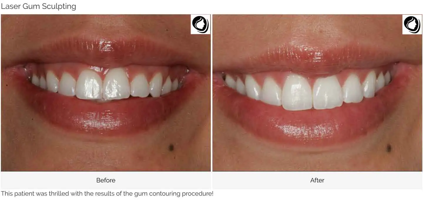 Laser gum sculpting case 1 before and after